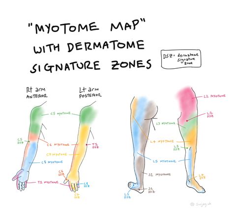Myotome Map To Remember Muscle Roots Dermatome Signature Zones R
