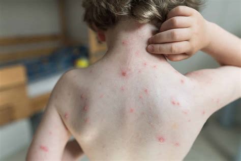 Common Skin Infections Focus On Kids Pediatrics