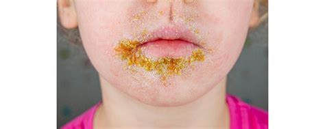 How To Care For Your Child With Impetigo Sidra Medicine