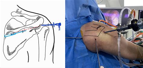 A Mid Scapular Portal For Arthroscopic Assisted Fixation Of Severe