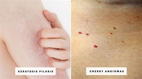 Bumpy skin that looks like tiny pinpricks or goosebumps could be keratosis pilaris. Skin Rash: 7 Causes of Red Spots and Bumps With Pictures ...