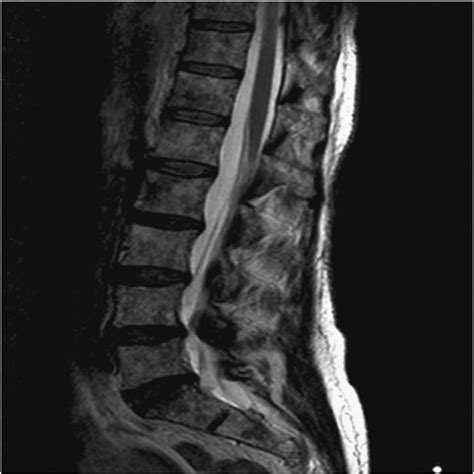 Mri Of Spine With Contrast Showing Diffusely Abnormal Marrow Signal