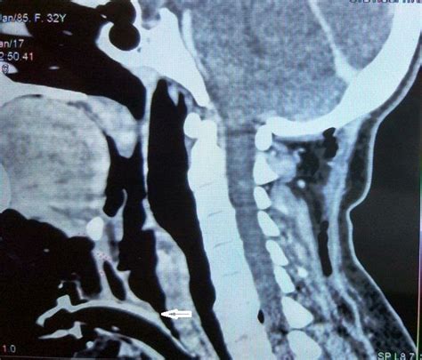 Ct Scan Of Neck Showing Stenosis Arrows Sagittal View Download