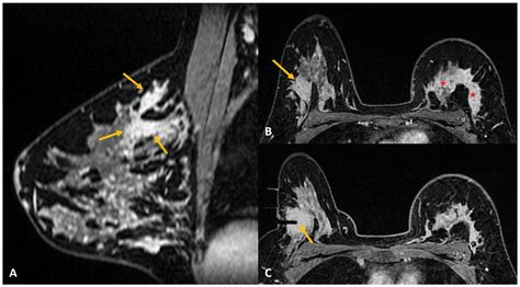Diagnostics Free Full Text Challenges In Mri Guided Breast Biopsy