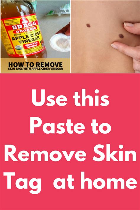 use this paste to remove skin tag at home this home remedy will remove skin… skin tags home