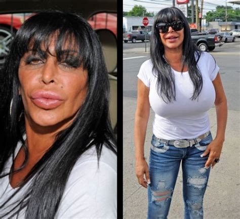 Plastic Surgery Gone Wrong Read More Celebrities Surgery News At