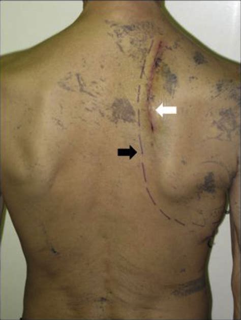 Video Assisted Thoracoscopic Surgical Lobectomy With Limited En Bloc