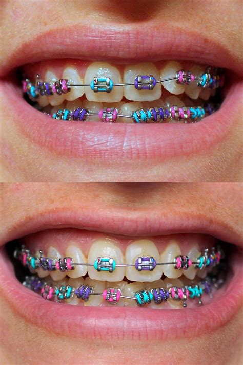 purple pink blue cute braces colors cute braces braces teeth colors