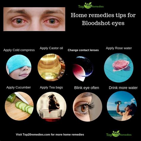 Best Bloodshot Eyes Home Remedies That Really Work Top 20 Remedies