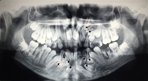 What does impacted tooth mean? Non-syndromic multiple impacted teeth: two case reports | Biomedical Research and Therapy