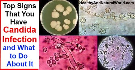Yeast Infection Caused By Wine Treatment Candida Nail Infection Signs