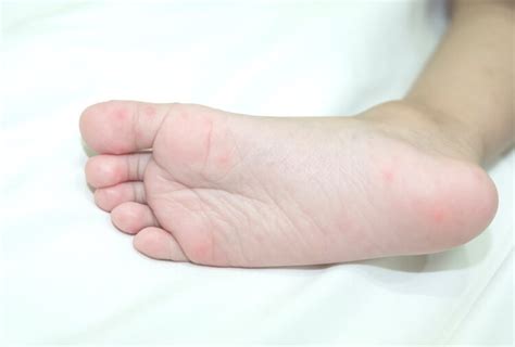 脚上的红斑原因和如何治疗 Beplay官