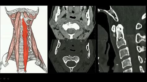 Rx Da Coluna Cervical Youtube