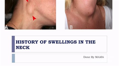 History Of The Neck Swelling And Lump Ca Surgery Youtube