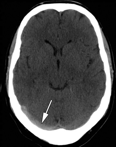 Two patients presented with hemorrhagic venous infarcts. Radiologic Clues to Cerebral Venous Thrombosis | RadioGraphics
