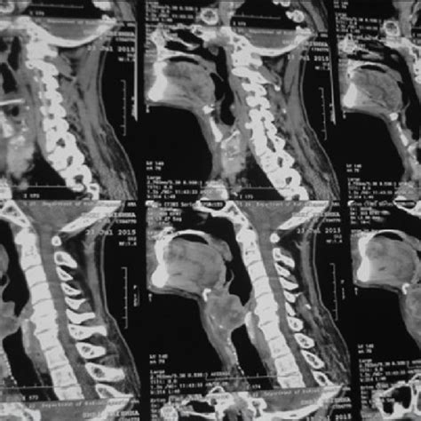 Sagittal Section Of Contrast Enhanced Ct Scan Neck Showing Hetrogenous