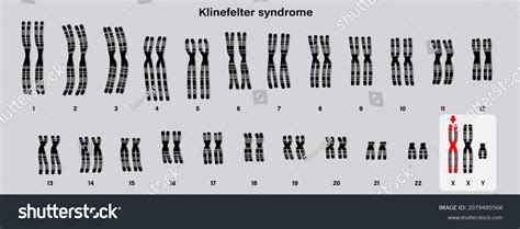 Human Karyotype Klinefelter Syndrome Klinefelters Ks Stock Vektor