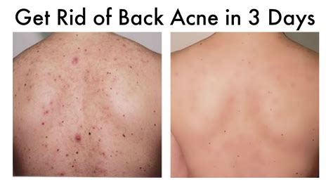 How To Treat Back Acne And Body Acne Youtube