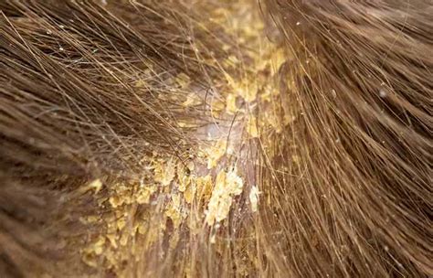 Scalp Problems Causes Symptoms Types And How To Take Care