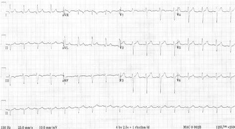 Left Anterior Fascicular Block Lafb Litfl Ecg Library Diagnosis