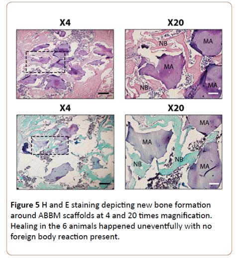 Novel Natural Bovine Bone Graft With Integrated Atelo Collagen Type I