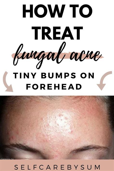 How To Treat Fungal Acnetiny Bumps On Forehead Self Care By Sum