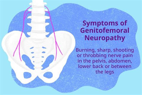 Genitofemoral Neuropathy Symptoms Cause And Treatment