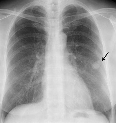 Ct Scan Lung Nodules