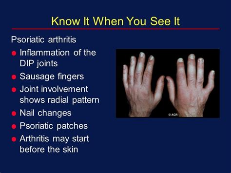 On This Pagepsoriatic Arthritis Symptomspsoriatic Arthritis Causes