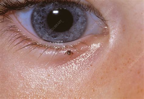 Tick Feeding On Eyelid Stock Image M3200318 Science Photo Library