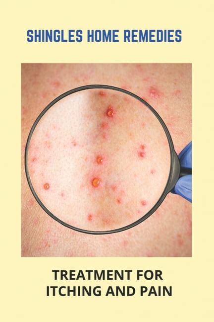 Shingles Home Remedies Treatment For Itching And Pain Shingles