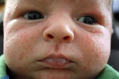 Some rashes can be quite mild and transient. Rash on baby - what causes baby facial rashes and how to ...