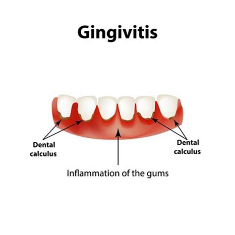 Gingivitis Treatment At Home How To Cure Gum Disease Without A