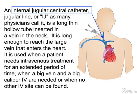 Internal Jugular Central Catheter