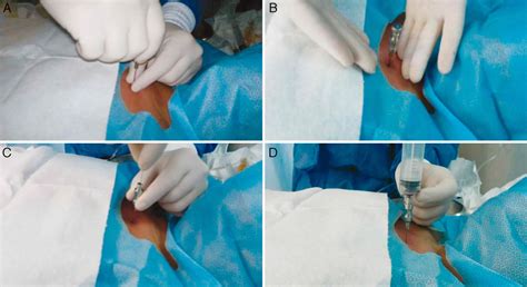 Check spelling or type a new query. Bone Marrow Biopsy - Reasons, Pain, Complications