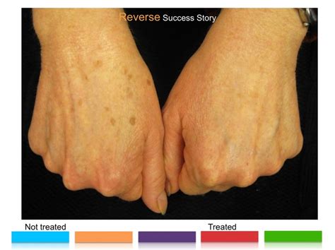 Get Rid Of Those Brown Spots On Your Hands And Arms Ask Me How