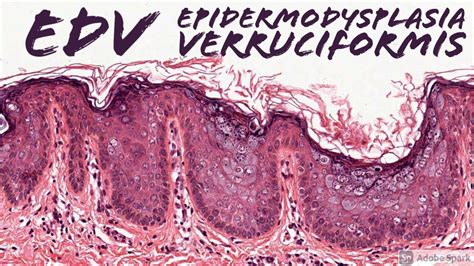 Epidermodysplasia Verruciformis Edv 5 Minute Pathology Pearls Youtube