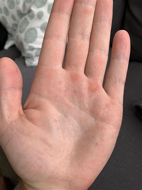 What Are These Small Bumps On The Palm Of My Hand I F Vrogue Co