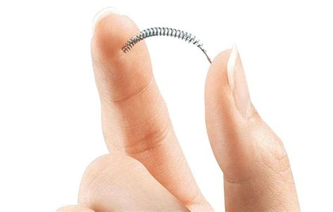 Implants Essure Comment Fonctionne La Contraception Définitive