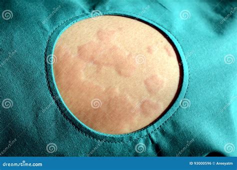 Skin Rash Urticaria Allergic Skin Reaction Stock Photo Image Of
