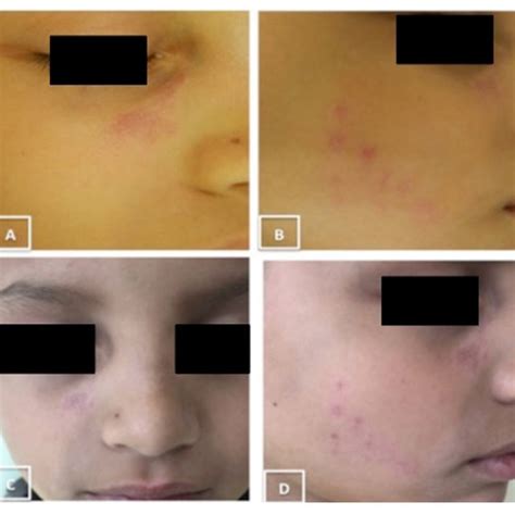 Pdf Lupus Erythematosus Tumidus In Childhood Treated With Antimalarials