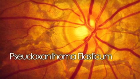 Pseudoxanthoma Elasticum Pxe And The Retina