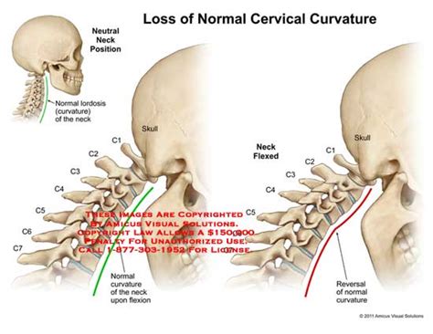 Amicus Illustration Of Amicusmedicalcervicalspinelosscurvature