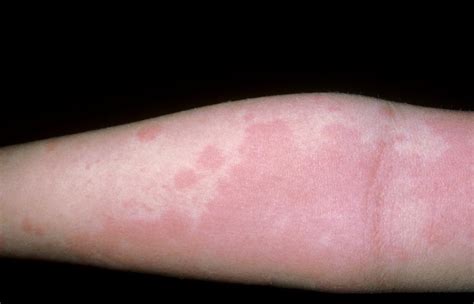 What 9 Common Skin Rashes Look Like