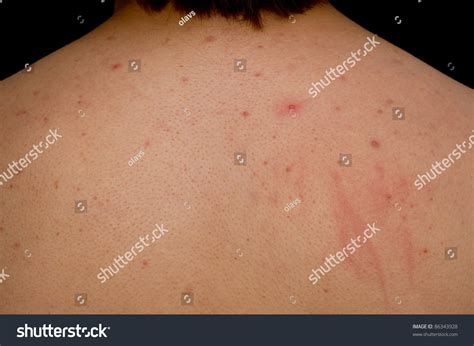 Acne On A Males Back Stock Photo 86343928 Shutterstock