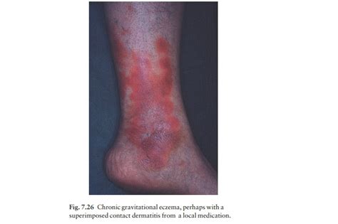 Gravitational Stasis Eczema