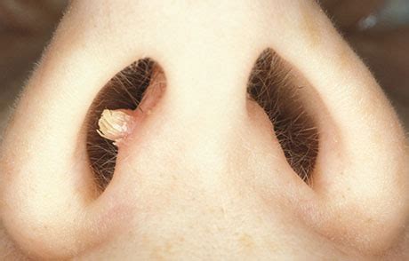 Why Does Nasal Papilloma Appear And How Dangerous Is It Papillomas My XXX Hot Girl
