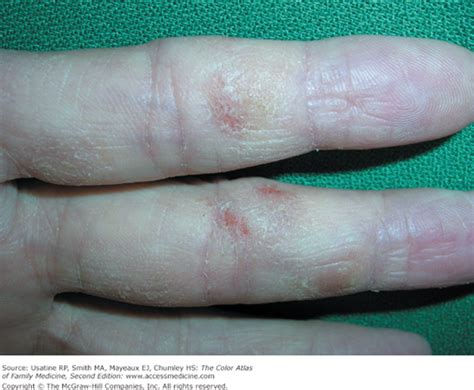 Hand Eczema Basicmedical Key