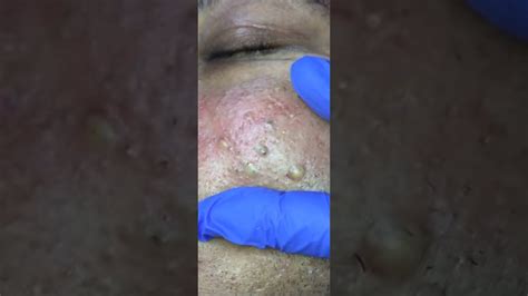 Blackheads Popping And Blackhead Removal Videos 2022 Youtube