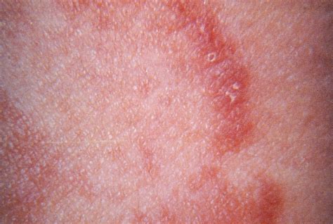 Fungal Skin Infection Of Many Colors Tinea Versicolor Pathogenesis Sexiz Pix